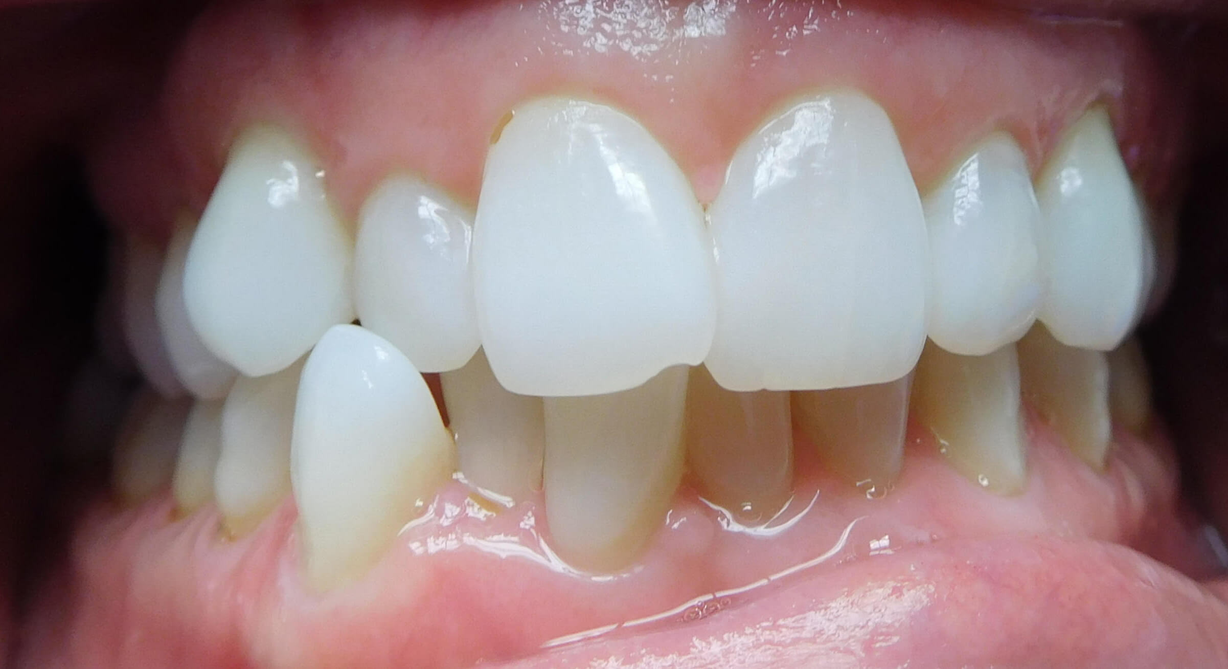 Invisalign - Dental Innovations